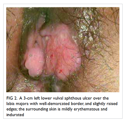 Genital Ulcer Disease (GUD) - Section 4 - Management and ...