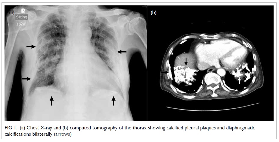 icd 10 code for malignant left pleural effusion