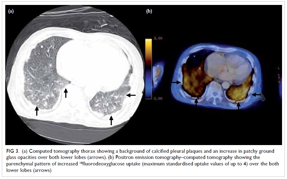 can costochondritis cause pain in left breast