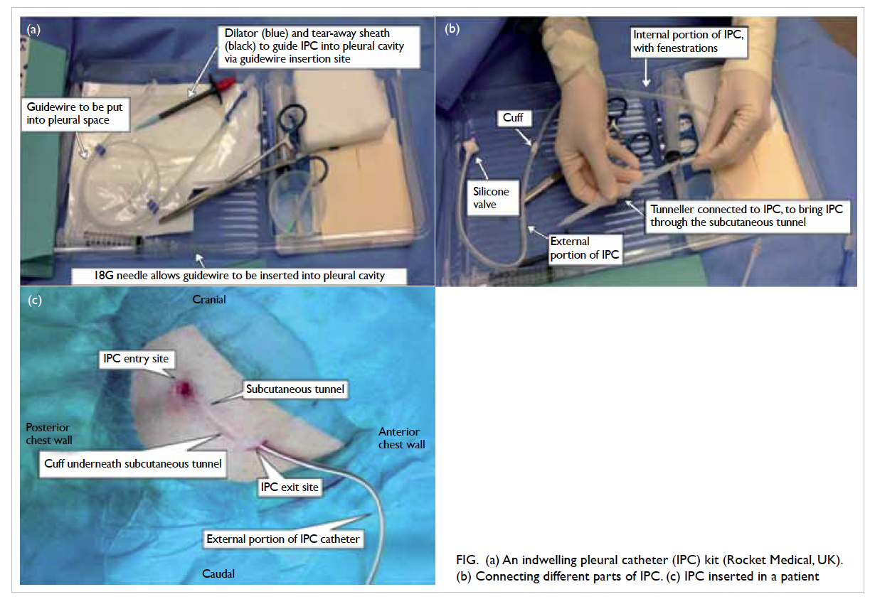 PDF) Indwelling Pleural Catheters for Malignant Pleural Effusion