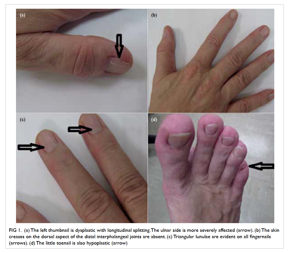A novel mutation in LMX1B gene in a newborn with nail‐patella syndrome:  Clinical and dermoscopic findings - Tognetti - 2020 - Pediatric Dermatology  - Wiley Online Library