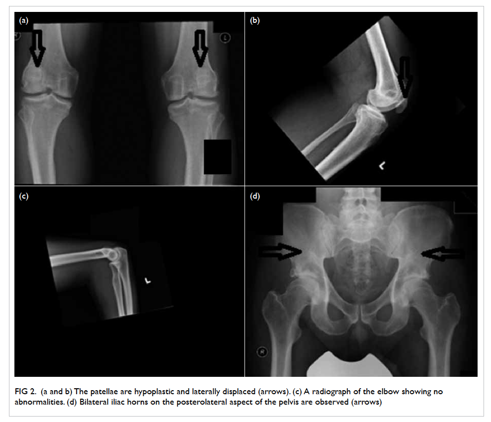 Bilateral Hip Dislocation and Pubic Diastasis in Familial Nail-Patella  Syndrome