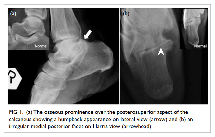 talocalcaneal coalition mri