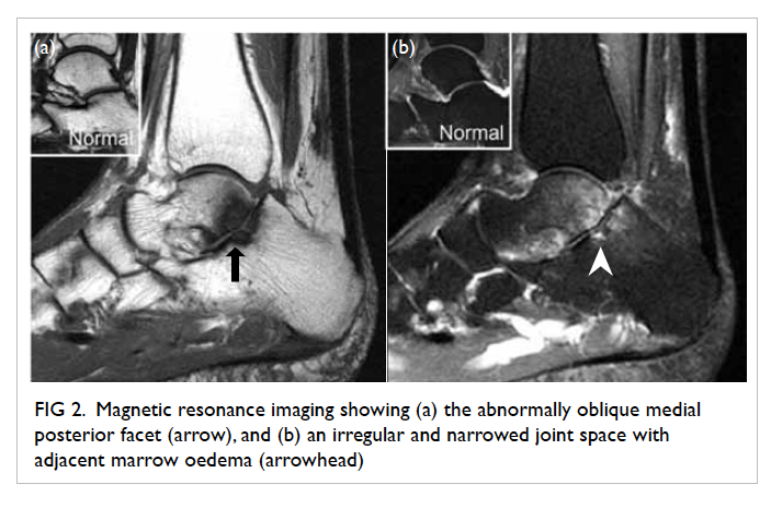 talocalcaneal coalition mri