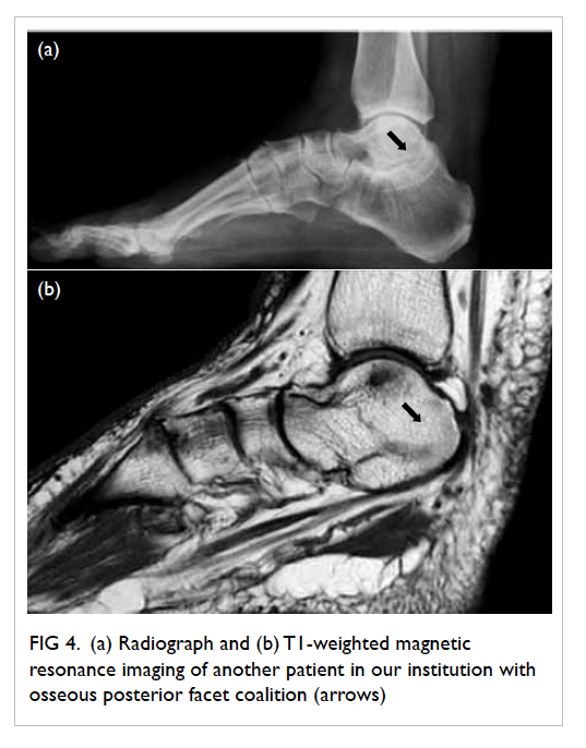 talocalcaneal coalition mri