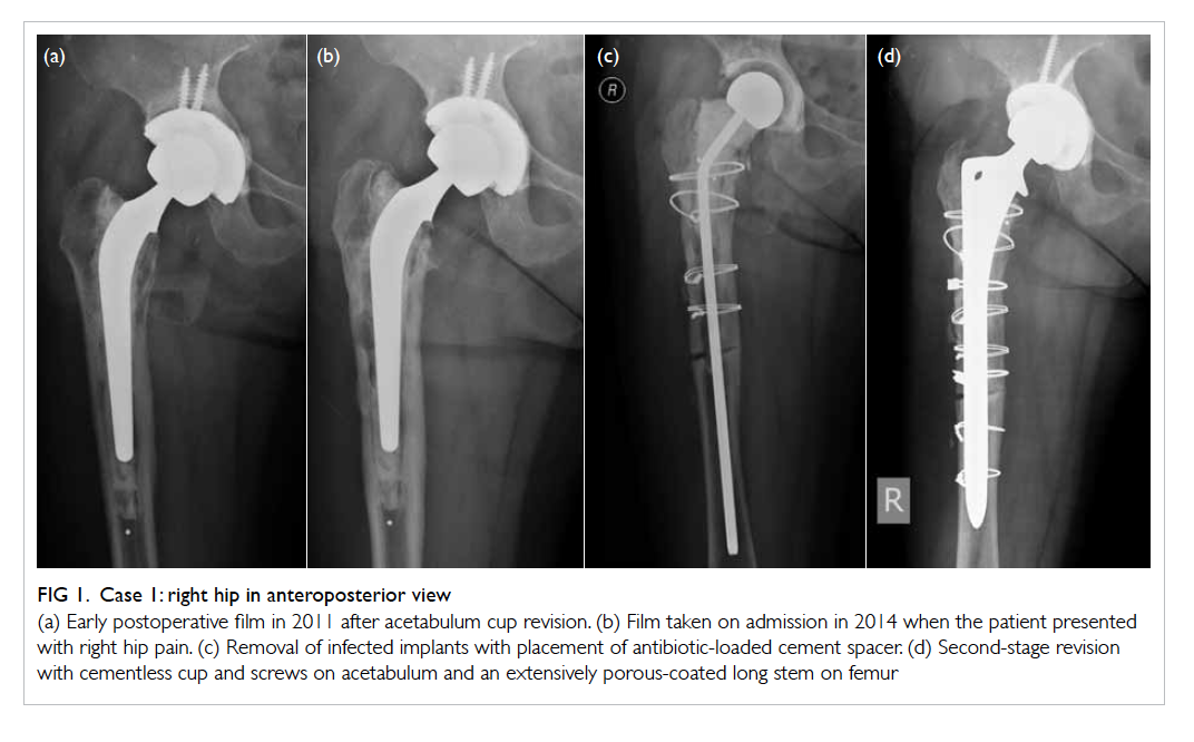 Hip Aspiration After Hip Replacement Doctorvisit