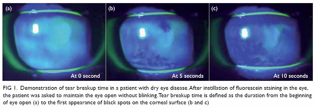 Update on the association between dry eye disease and meibomian gland | HKMJ