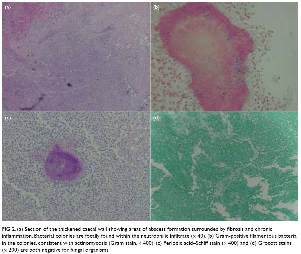 Actinomycosis Gram Stain