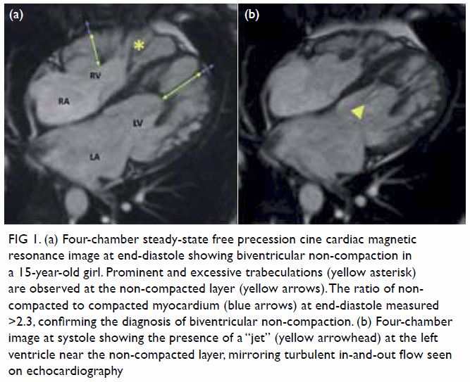 Cardiac magnetic resonance imaging in the diagnosis of biventricular  non-compaction in a young but failing heart