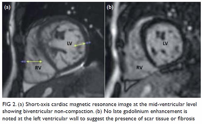 Cardiac magnetic resonance imaging in the diagnosis of biventricular  non-compaction in a young but failing heart