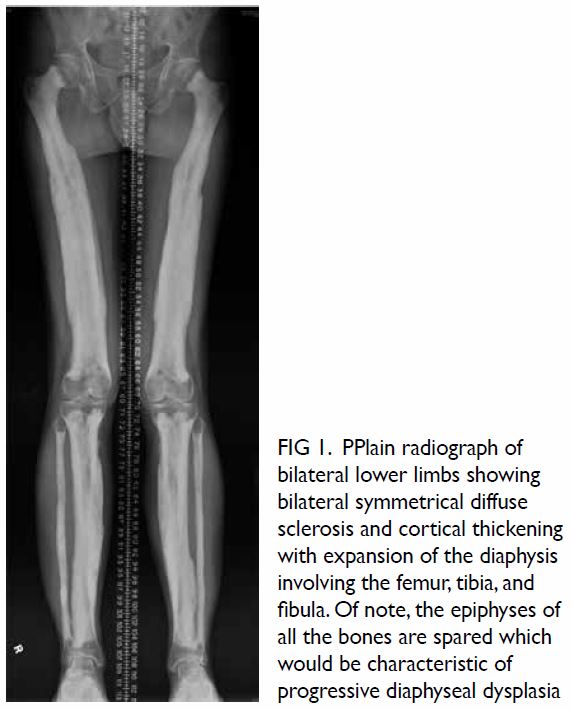 Lateral radiograph of the left tibia demonstrating the characteristic