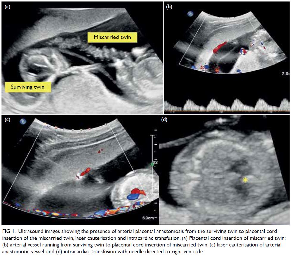 Combined Interstitial Laser Cauterisation Of Placental Anastomosis And