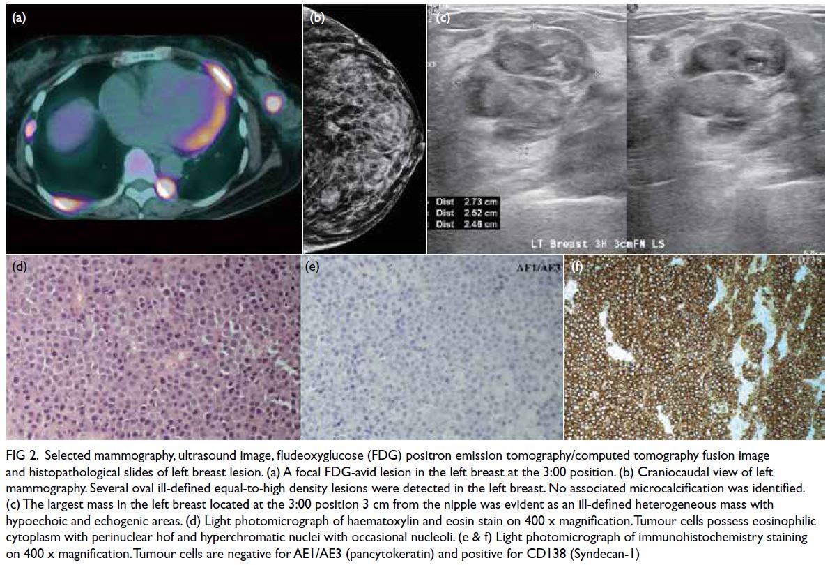 Initial presentation of the patient: (A) double nipple lesions; (B