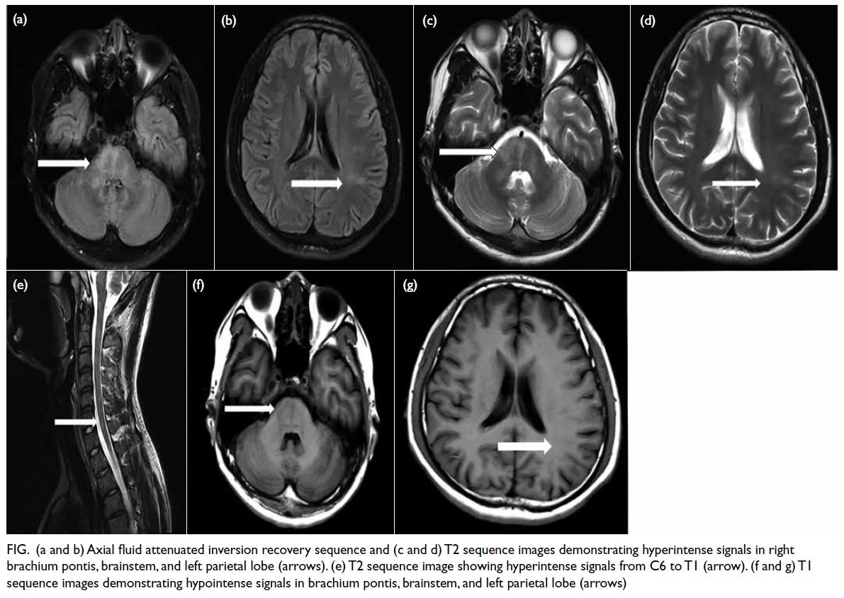 Cureus | An Unusual Case of Candida albicans Empyema in Patient With  Gastric Cancer and Colon Metastasis | Article