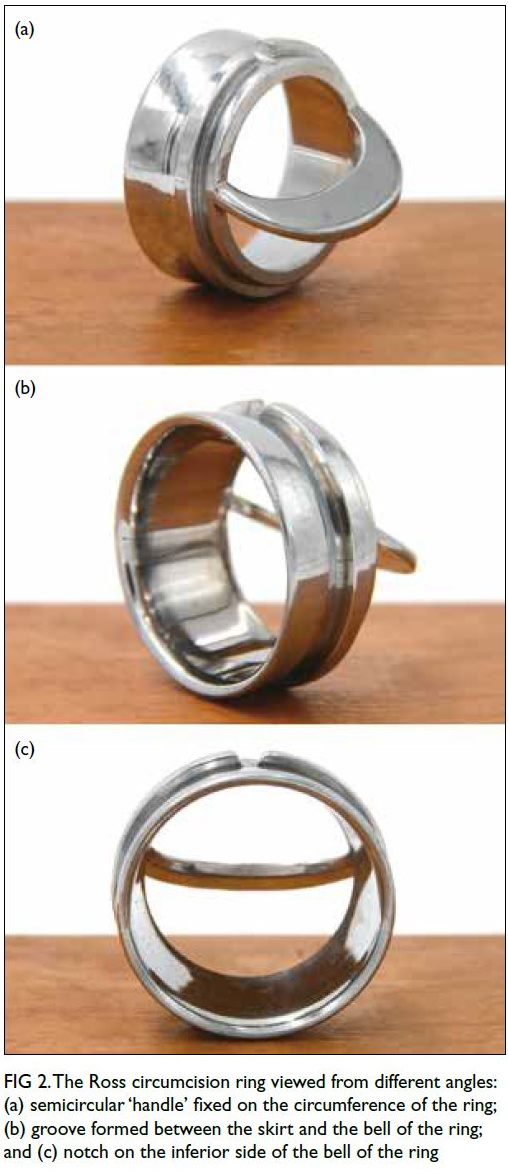 Disposable circumcision suture devices versus Shang ring circumcision for  management of redundant prepuce or phimosis: A systematic review and  meta-analysis - ScienceDirect